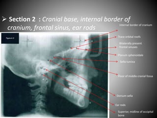  Section 2 : Cranial base, internal border of
cranium, frontal sinus, ear rods
internal border of cranium
Trace orbital roofs
Sella turcica
Planum sphenoidale
Bilaterally present
frontal sinuses
Dorsum sella
Superior, midline of occipital
bone
Floor of middle cranial fossa
Ear rods
 