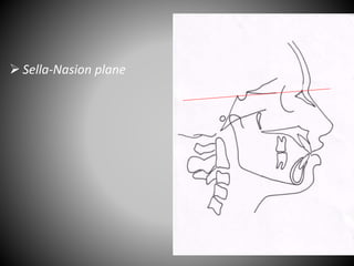  Sella-Nasion plane
S N
 