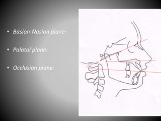 • Basion-Nasion plane:
• Palatal plane:
• Occlusion plane:
Ba
N
ANSPNS
 