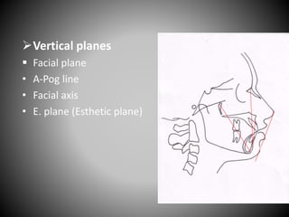 Vertical planes
 Facial plane
• A-Pog line
• Facial axis
• E. plane (Esthetic plane)
Ptm
Gn
N
Pog
A
E plane
 