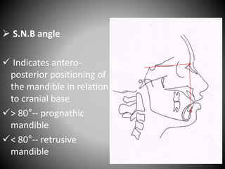  S.N.B angle
 Indicates antero-
posterior positioning of
the mandible in relation
to cranial base
> 80°-- prognathic
mandible
< 80°-- retrusive
mandible
S
N
B
Mean value-- 80°
 