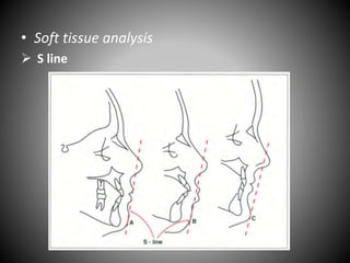 • Soft tissue analysis
 S line
 