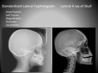 Head Position
Soft Tissues
Magnification
Occlusion
Lip position
Standardized Lateral Cephalogram Lateral X ray of Skull
 