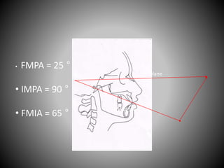 • FMPA = 25 °
• IMPA = 90 °
• FMIA = 65 °
FH plane
Mand plane
 