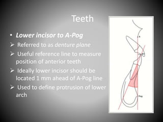 Teeth
• Lower incisor to A-Pog
 Referred to as denture plane
 Useful reference line to measure
position of anterior teeth
 Ideally lower incisor should be
located 1 mm ahead of A-Pog line
 Used to define protrusion of lower
arch
 