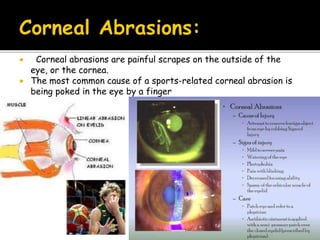  Corneal abrasions are painful scrapes on the outside of the
eye, or the cornea.
 The most common cause of a sports-related corneal abrasion is
being poked in the eye by a finger
 