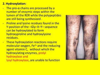 2. Hydroxylation:
- The pro-α chains are processed by a
number of enzymic steps within the
lumen of the RER while the polypeptides
are still being synthesized .
- Proline and lysine residues found in the
Y-position of the –Gly–X–Y– sequence
can be hydroxylated to form
hydroxyproline and hydroxylysine
residues.
- These hydroxylation reactions require
molecular oxygen, Fe2+ and the reducing
agent vitamin C, without which the
hydroxylating enzymes, prolyl
hydroxylase and
lysyl hydroxylase, are unable to function
 