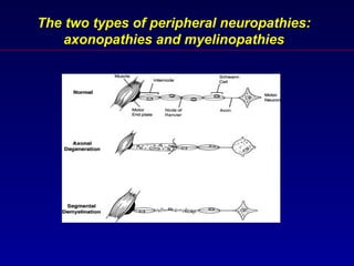 LEC.15. Neuropathy.ppt LEC.15. Neuropathy.ppt