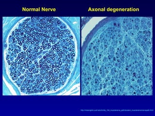 LEC.15. Neuropathy.ppt LEC.15. Neuropathy.ppt