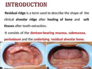 Comprehensive Overview of Residual Ridge Resorption in Dentistry | PPTX