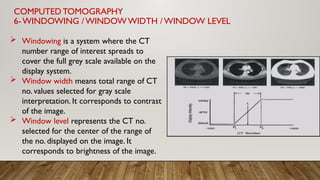 Window Ring Ct Comprehensive Overview of Computed Tomography (CT) in Medical Imaging ...