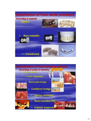 [Crown & Bridges] [terminology & classification] | PDF