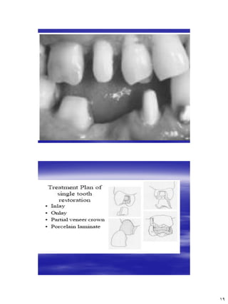 [Crown & Bridges] [terminology & classification] | PDF
