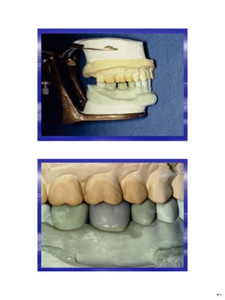 [Crown & Bridges] [terminology & classification] | PDF