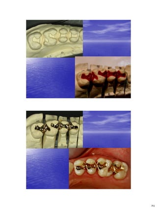 [Crown & Bridges] [terminology & classification] | PDF