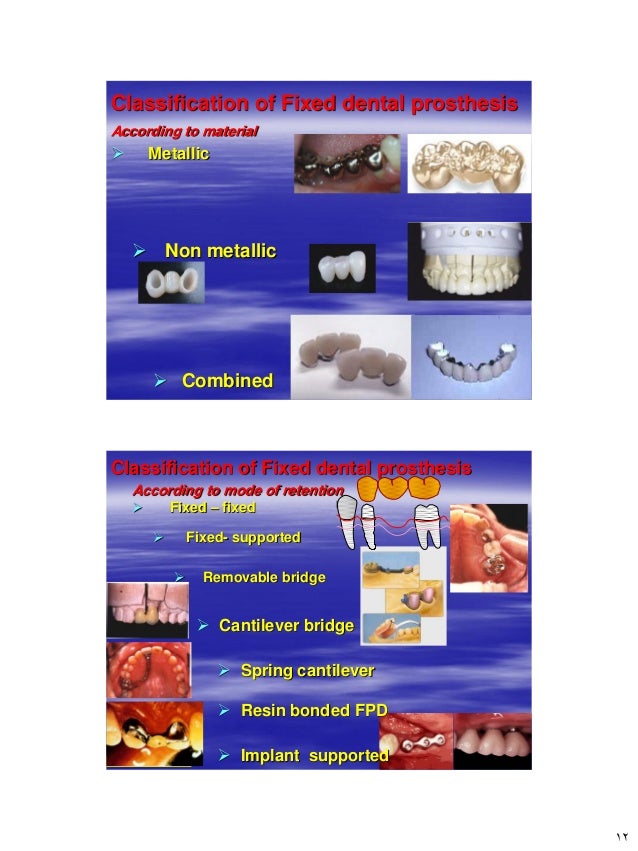 [Crown & Bridges] [terminology & classification]