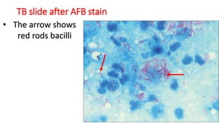 TB slide after AFB stain
• The arrow shows
red rods bacilli
 