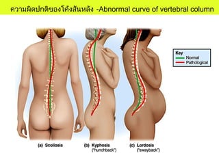 ความผิดปกติของโค้งสันหลัง -Abnormal curve of vertebral column
 