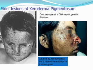 Skin lesions of Xeroderma Pigmentosum
Caused by homozygosity
For a recessive mutation in
A repair gene.
One example of a DNA-repair genetic
disease
 