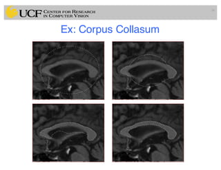 Lec11: Active Contour and Level Set for Medical Image Segmentation | PDF