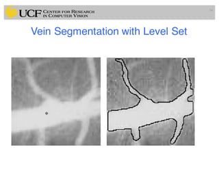 Lec11: Active Contour and Level Set for Medical Image Segmentation | PDF