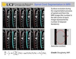 Lec11: Active Contour and Level Set for Medical Image Segmentation | PDF