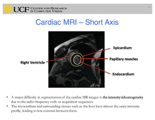 Lec11: Active Contour and Level Set for Medical Image Segmentation | PDF