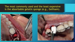 Tooth Extraction Scab Complications of tooth extraction 2 | PPTX