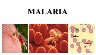 MALARIA
1
 