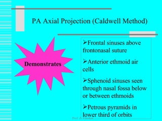 PA Axial Projection (Caldwell Method) Prof. Z. Vinokur Demonstrates Frontal sinuses above frontonasal suture Anterior ethmoid air cells  Sphenoid sinuses seen through nasal fossa below or between ethmoids Petrous pyramids in lower third of orbits  