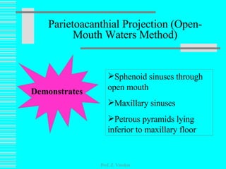 Parietoacanthial Projection (Open-Mouth Waters Method) Prof. Z. Vinokur Demonstrates Sphenoid sinuses through open mouth Maxillary sinuses Petrous pyramids lying inferior to maxillary floor 