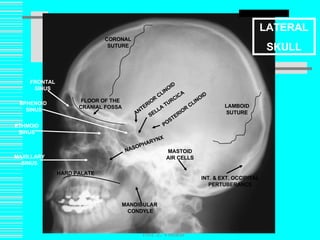 Prof. Z. Vinokur L LATERAL SKULL CORONAL SUTURE LAMBOID SUTURE INT. & EXT. OCCIPITAL PERTUBERANCE MASTOID AIR CELLS HARD PALATE NASOPHARYNX ANTERIOR CLINOID POSTERIOR CLINOID MANDIBULAR  CONDYLE FLOOR OF THE CRANIAL FOSSA SELLA TURCICA FRONTAL SINUS MAXILLARY SINUS SPHENOID  SINUS ETHMOID SINUS 