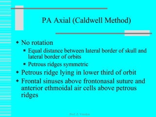 PA Axial (Caldwell Method) No rotation Equal distance between lateral border of skull and lateral border of orbits Petrous ridges symmetric Petrous ridge lying in lower third of orbit Frontal sinuses above frontonasal suture and anterior ethmoidal air cells above petrous ridges Prof. Z. Vinokur 