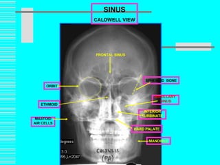Prof. Z. Vinokur SINUS CALDWELL VIEW FRONTAL SINUS SPHENOID   BONE MAXILLARY  SINUS INFERIOR TURBINATE MANDIBLE HARD PALATE MASTOID AIR CELLS ORBIT ETHMOID 