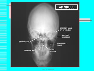 Prof. Z. Vinokur ETHMOID SINUS NASAL SEPTUM MASTOID AIR CELLS MAXILLARY SINUS MAXILLA GREATER WING OF  SPHENOID AP SKULL 