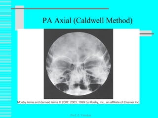 PA Axial (Caldwell Method) Prof. Z. Vinokur 