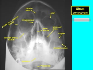 Prof. Z. Vinokur Sinus WATERS VIEW MANDIBLE FRONTAL  SINUS ETHMOID SINUS MAXILLARY SINUS ZYGOMA ZYGOMATIC ARCH INFERIOR ORBITAL MARGIN ORBIT NASAL SEPTUM ZYGOMATICAL –FRONTAL SUTURE ODONTOID 