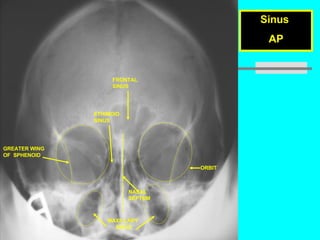 Prof. Z. Vinokur Sinus  AP FRONTAL  SINUS ETHIMOID  SINUS ORBIT NASAL SEPTUM GREATER WING  OF  SPHENOID MAXILLARY  SINUS 
