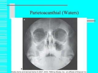 Parietoacanthial (Waters) Prof. Z. Vinokur 
