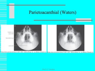 Parietoacanthial (Waters) Prof. Z. Vinokur 