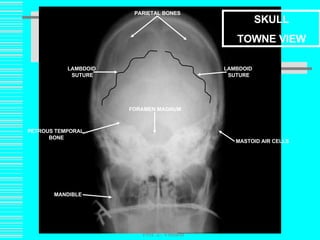 Prof. Z. Vinokur SKULL TOWNE VIEW MANDIBLE MASTOID AIR CELLS PETROUS TEMPORAL  BONE FORAMEN MAGNUM PARIETAL BONES LAMBDOID  SUTURE LAMBDOID  SUTURE 