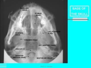 Prof. Z. Vinokur ODONTOID PROCESS (DENS) ETHMOID SINUS SPHENOID SINUS MAXILLARY SINUS LAT. PTYERGOID PLATE FORAMEN OVALE ARCH OF C-1 EXT. AUDITORY CANAL MASTOID AIR CELLS BASE OF  THE SKULL 