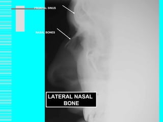 Prof. Z. Vinokur FRONTAL SINUS LATERAL NASAL BONE NASAL BONES 