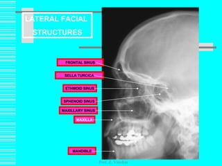 Prof. Z. Vinokur FRONTAL SINUS MAXILLARY SINUS MANDIBLE MAXILLA ETHMOID SINUS SELLA   TURCICA SPHENOID SINUS LATERAL FACIAL  STRUCTURES 