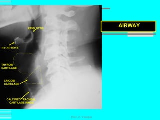 Prof. Z. Vinokur AIRWAY EPIGLOTTIS HYOID BONE CALCIFIED TRACHEAL CARTILAGE RINGS THYROID  CARTILAGE CRICOID  CARTILAGE 