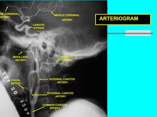 Prof. Z. Vinokur ARTERIOGRAM  CAROTID SYPHON OCCIPITAL ARTERY INTERNAL CAROTID ARTERY EXTERNAL CAROTID  ARTERY COMMON CAROTID ARTERY MAXILLARY ARTERY MIDDLE CEREBRAL ARTERY ANTERIOR CEREBRAL ARTERY FACIAL ARTERY 