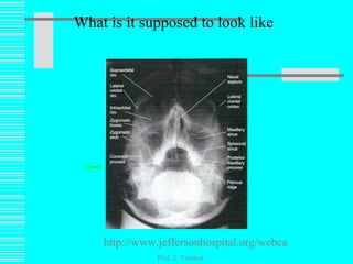 What is it supposed to look like Prof. Z. Vinokur http://www.jeffersonhospital.org/webcast/sinus/index.html 