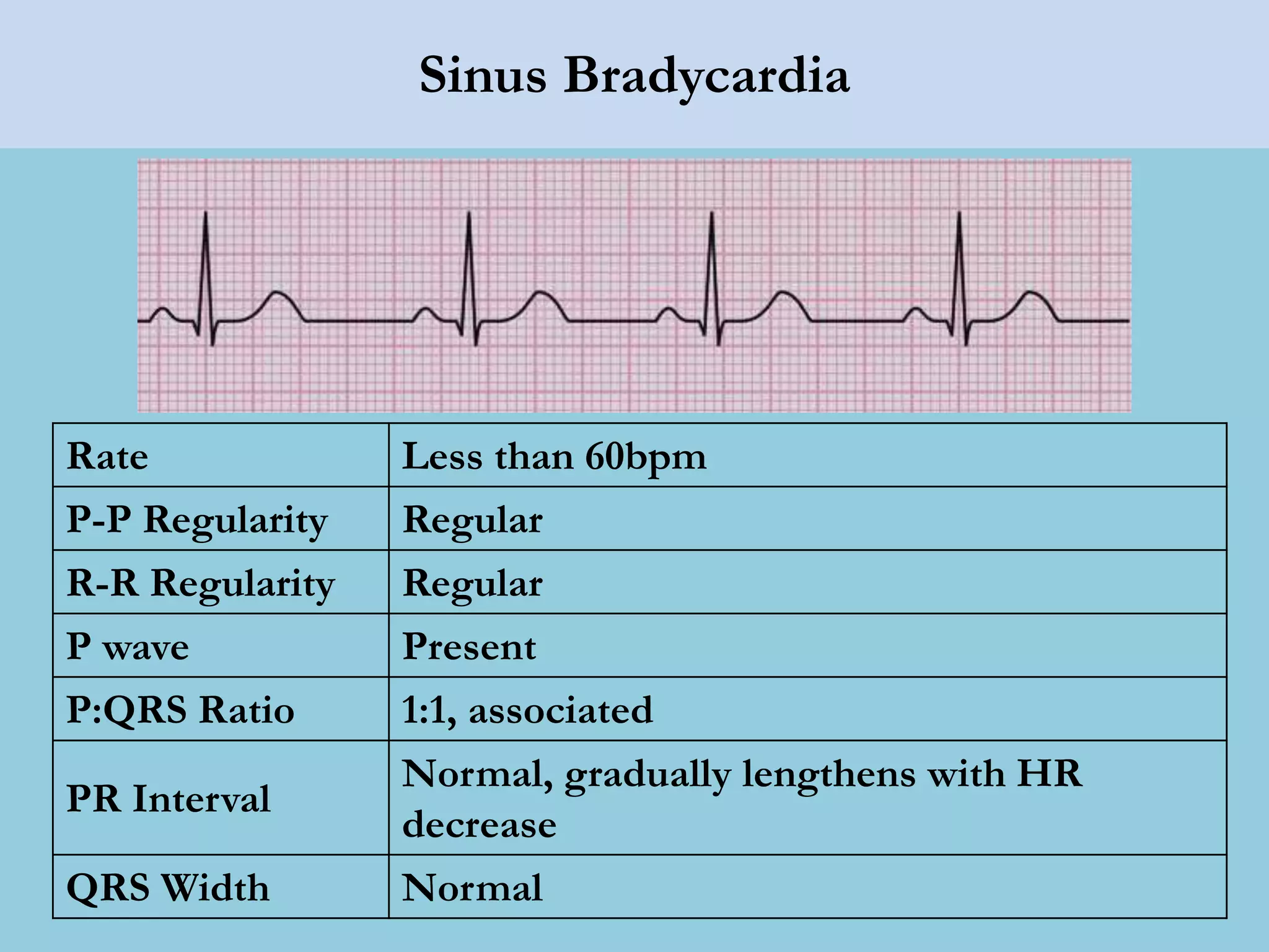 Lec 14 basic ecg interpretation for mohs | PPTX