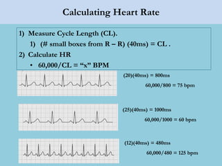 Calculating Heart Rate
1) Measure Cycle Length (CL).
1) (# small boxes from R – R) (40ms) = CL .
2) Calculate HR
• 60,000/CL = “x” BPM
(20)(40ms) = 800ms
60,000/800 = 75 bpm
(25)(40ms) = 1000ms
60,000/1000 = 60 bpm
(12)(40ms) = 480ms
60,000/480 = 125 bpm
 
