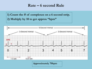Rate – 6 second Rule
1) Count the # of complexes on a 6 second strip.
2) Multiply by 10 to get approx “bpm”
0 1 2 3 4 5 6 7
Approximately 70bpm
 